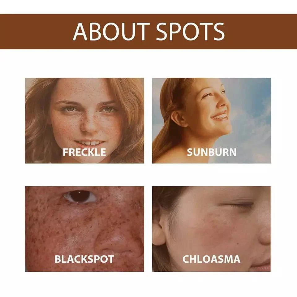 Anti Freckle Serum (Original) | Dark Spot Correction & Pigmentation Treatment