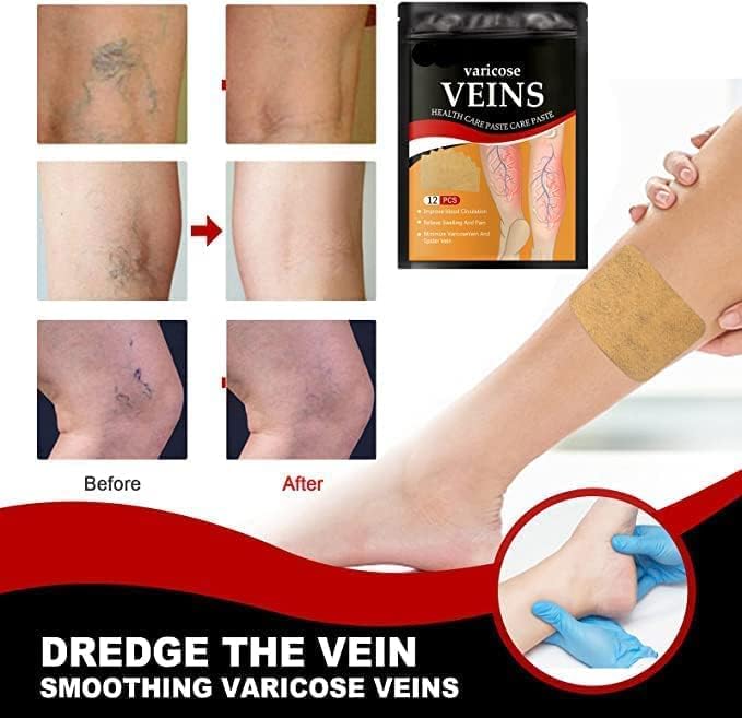 Hanel Varicose Veins Patch (Original) | Targeted Relief for Swelling & Vein Pain