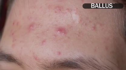 Pore Cleaning Devices & Blackhead Vacuums | Deep Facial Cleansing