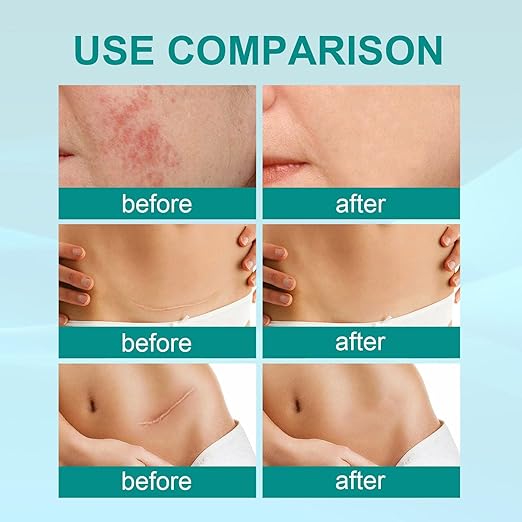 South Moon Scar Spray | Scar Reduction, Acne Marks & Stretch Mark Repair