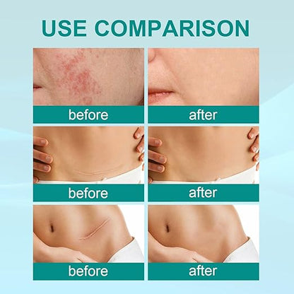 South Moon Scar Spray | Scar Reduction, Acne Marks & Stretch Mark Repair