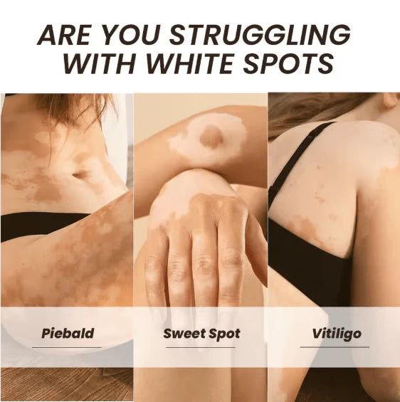 Sumifun Vitiligo Care Cream (Original) | Reduces White Spots & Improves Pigmentation