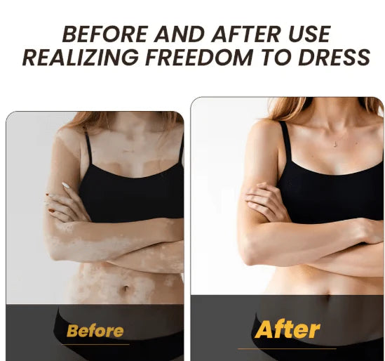 Sumifun Vitiligo Care Cream (Original) | Reduces White Spots & Improves Pigmentation